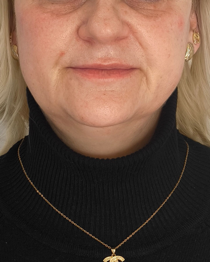 Omladený profil a redukcia kruhov pod očami po aplikácii kyseliny hyalurónovej