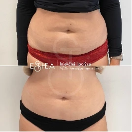 Výsledok injekčnej lipolýzy brucha pred a po zákroku – viditeľná redukcia tuku a zúženie pásu o 4 cm