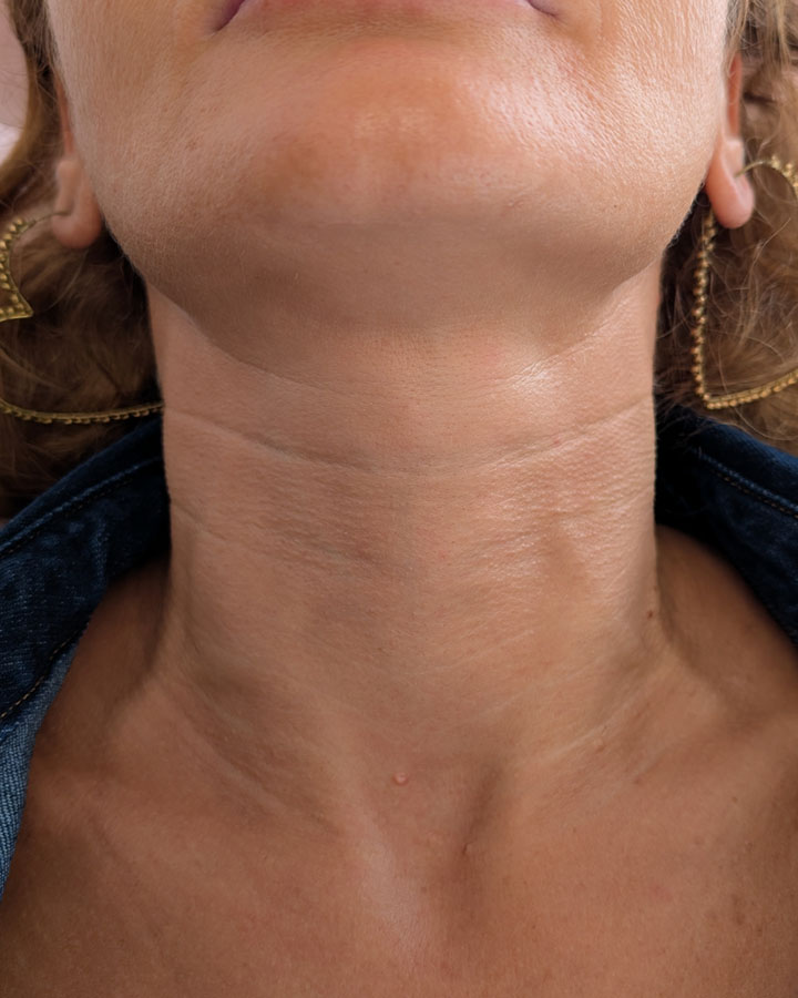 Omladený vzhľad krku s hladšou pokožkou po aplikácii stimulátora Gouri v klinike Esthea