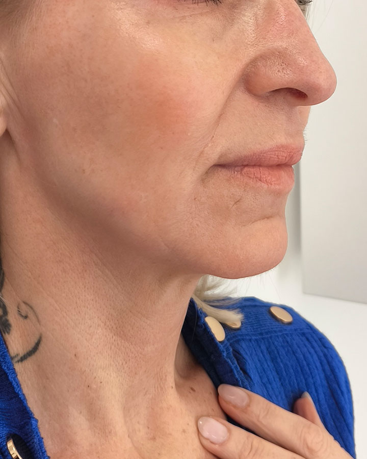 Mladistvý a svieži vzhľad tváre po 2 mesiacoch od ošetrenia v klinike Esthea
