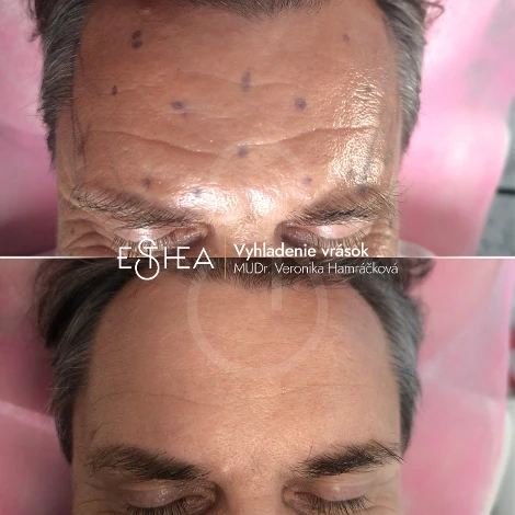 Koláž premeny pred a po vyhladení hlbokých vrások na čele a vrásky hnevu u muža pomocou botoxu v Esthea