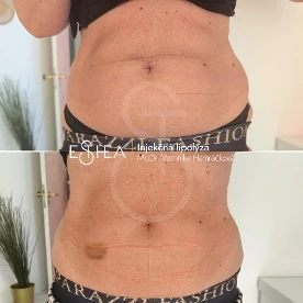 Premena pred a po lipolýze brucha – úbytok lokálneho tuku a zmenšenie obvodu pásu o 3 cm v Esthea